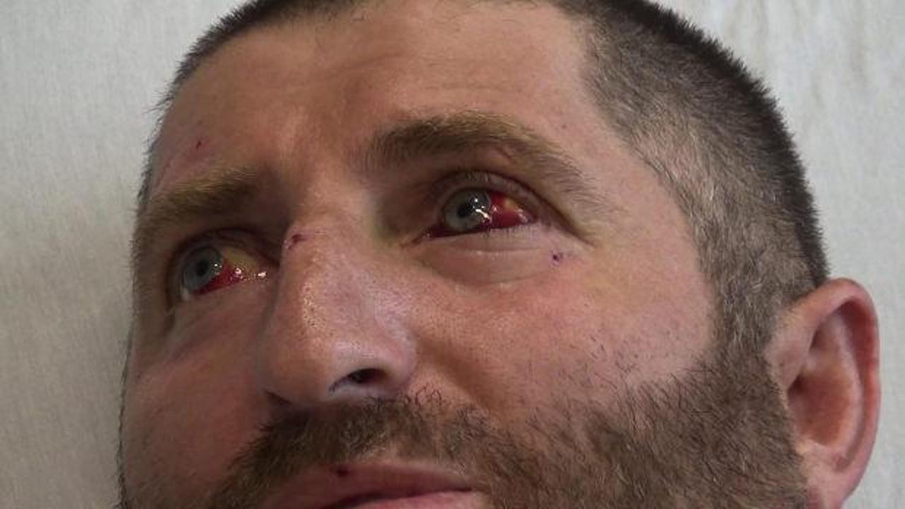 Erzincan'da yüksek gerilim hattında feci iş kazası: Vücudunun üçte biri yandı