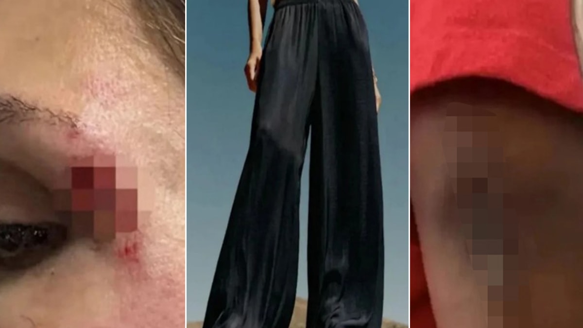 Moda tutkusu yaralanmayla sonuçlandı: Aşırı bol kesim pantolonlar tehlike saçıyor